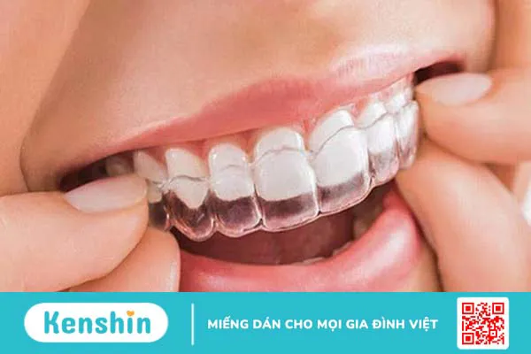 40 tuổi có niềng răng được không? Giải thích đầy đủ 1