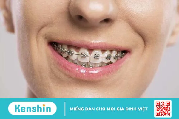 40 tuổi có niềng răng được không? Giải thích đầy đủ 2