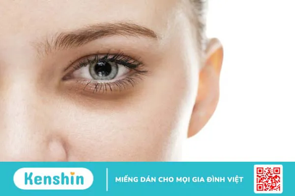 8 mẹo để giảm quầng thâm và sự mệt mỏi dưới mắt 1