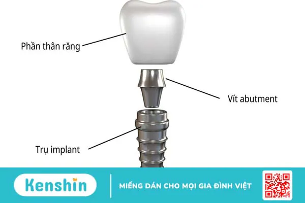 Abutment: Cấu tạo, đặc điểm, phân loại và lưu ý 1