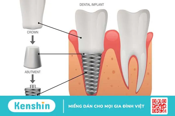 Abutment: Cấu tạo, đặc điểm, phân loại và lưu ý 2