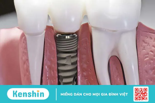 Abutment: Cấu tạo, đặc điểm, phân loại và lưu ý 3