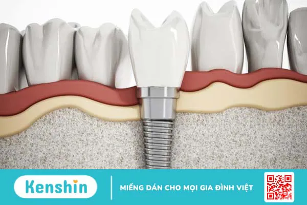 Abutment: Cấu tạo, đặc điểm, phân loại và lưu ý 4