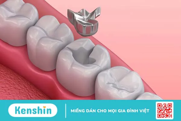 Amalgam là gì? Một số thông tin bạn cần biết về vật liệu trám răng Amalgam 1