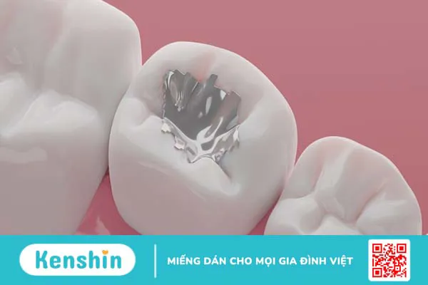 Amalgam là gì? Một số thông tin bạn cần biết về vật liệu trám răng Amalgam 4