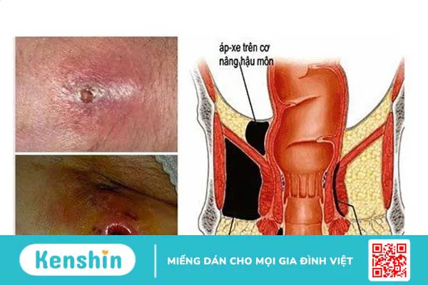 Áp xe cạnh hậu môn: Nguyên nhân, triệu chứng và điều trị 1