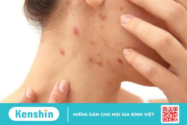 Mụn xuất hiện ở bà bầu chủ yếu do thay đổi nội tiết