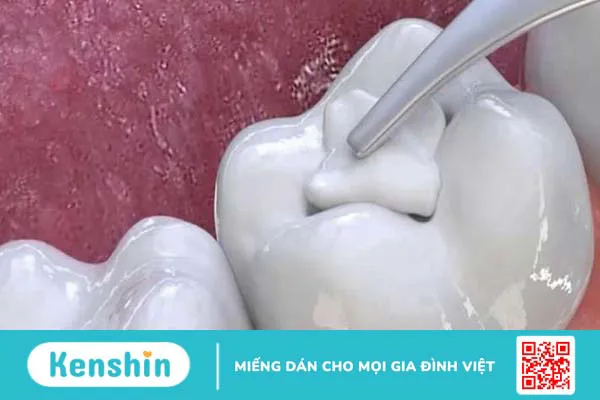 Bầu có trám răng được không? Có ảnh hưởng đến thai nhi không? 3