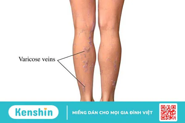 Bấm huyệt chữa suy giãn tĩnh mạch 1