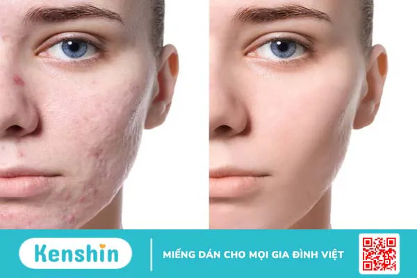 Bạn cần lưu ý gì trong điều trị sẹo lõm?1