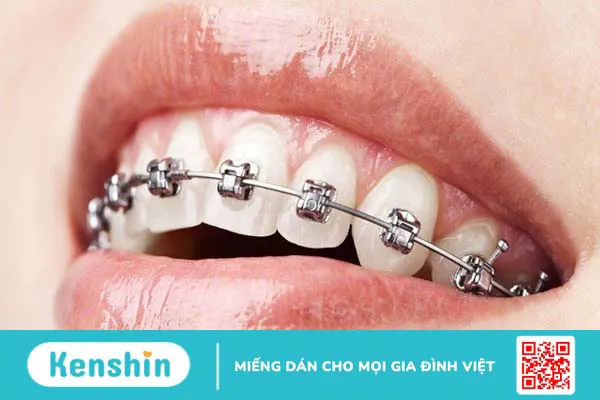 Band niềng răng là gì? Gắn band niềng răng có đau không? 1