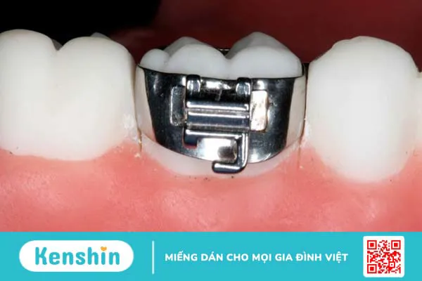 Band niềng răng là gì? Gắn band niềng răng có đau không? 2