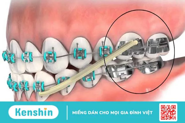 Band niềng răng là gì? Gắn band niềng răng có đau không? 3