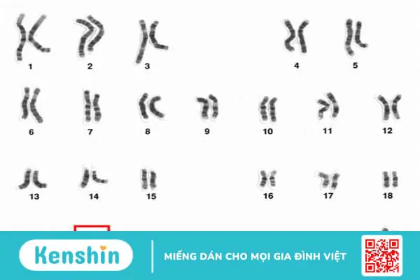 Bất thường nhiễm sắc thể số 19 gây ra những bệnh nào?3