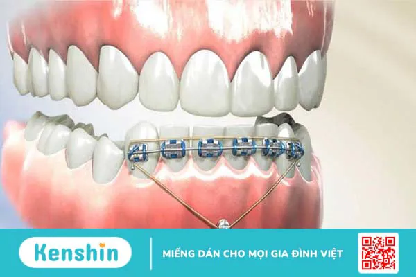 Bắt vít niềng răng là gì? Khi nào cần thực hiện bắt vít niềng răng? 1