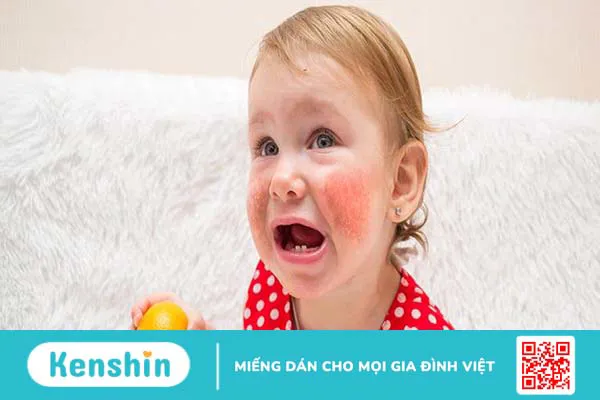 Bé bị phát ban nhưng không sốt có nguy hiểm không và những cách xử lý mẹ cần biết