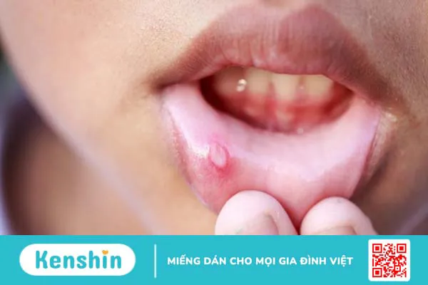 Bệnh Behcet là bệnh gì? Cách chẩn đoán và điều trị bệnh Behcet 1