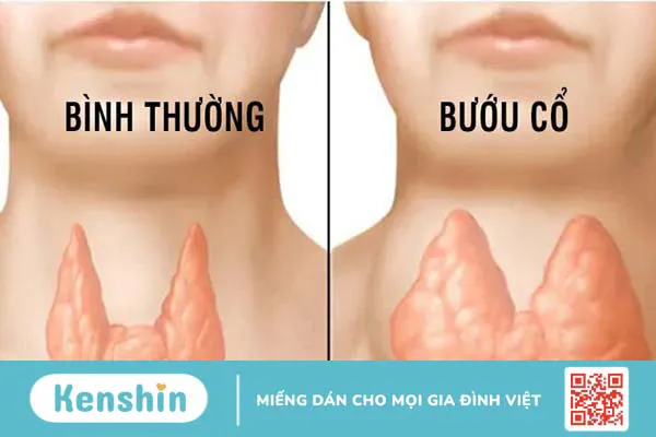 Bệnh bướu cổ có nguy hiểm không? 1