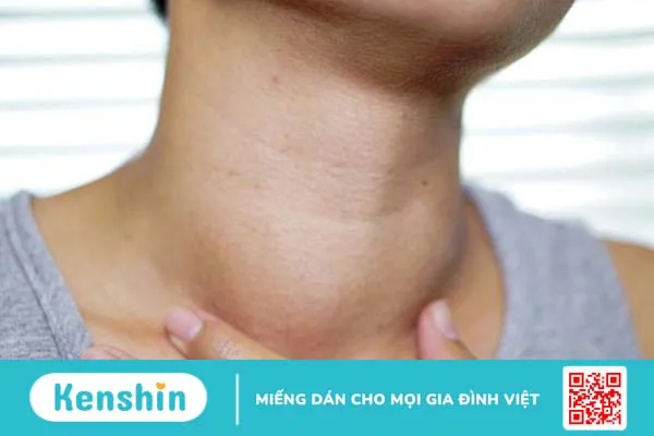 Bệnh bướu cổ có nguy hiểm không? 3