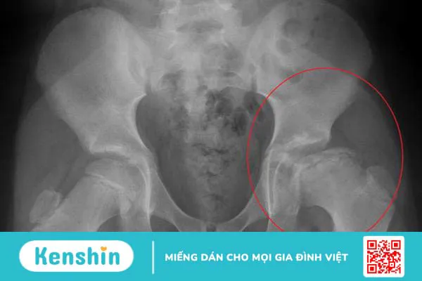 Dẹt chỏm xương đùi là bệnh như thế nào?1