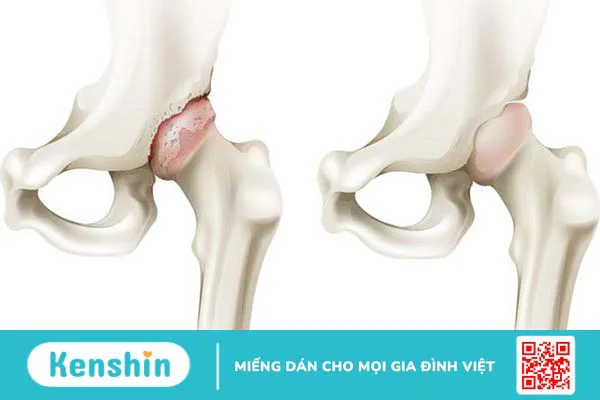 Dẹt chỏm xương đùi là bệnh như thế nào?2