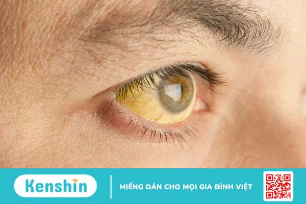 Bệnh gan mật: Nhận biết sớm qua 4 triệu chứng bất thường của cơ thể 2