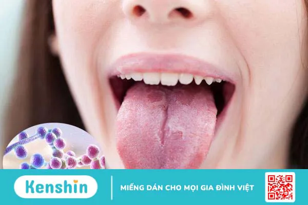 Bệnh nấm đường tiêu hóa và những điều cần biết 1