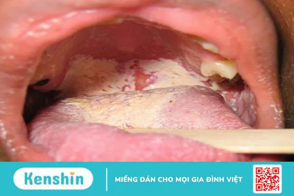 Bệnh nấm đường tiêu hóa và những điều cần biết 2