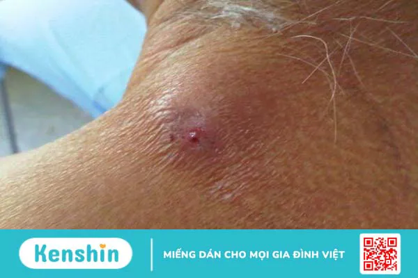 Bệnh nhiễm giòi Maggot: Nguyên nhân, triệu chứng, điều trị và phòng chống 2