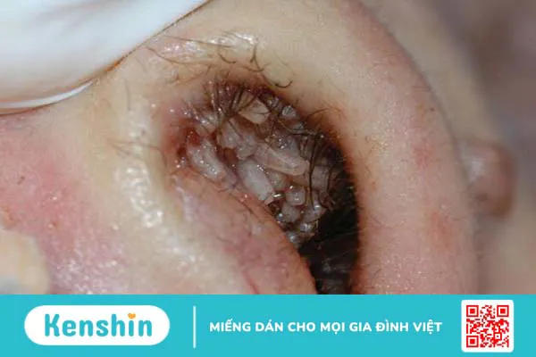 Bệnh nhiễm giòi Maggot: Nguyên nhân, triệu chứng, điều trị và phòng chống 3