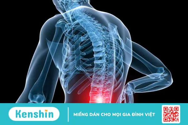 Bệnh rễ thần kinh thắt lưng: Nguyên nhân, triệu chứng và cách khắc phục 1