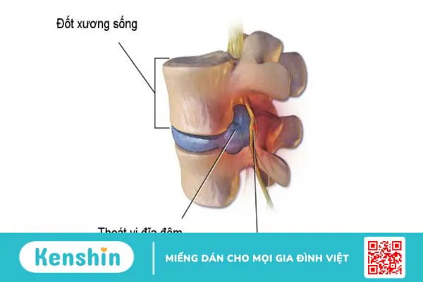 Bệnh rễ thần kinh thắt lưng: Nguyên nhân, triệu chứng và cách khắc phục 3