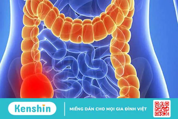 Bệnh viêm hồi tràng: Tìm hiểu nguyên nhân, triệu chứng, cách điều trị bệnh 2