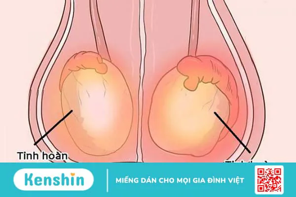 Bệnh viêm mào tinh hoàn có tự khỏi không?