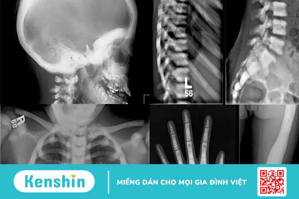 Bệnh xương hóa đá và những rủi ro tiềm ẩn 1