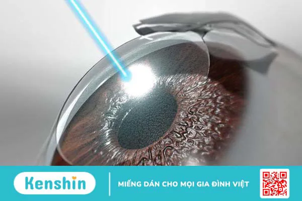 Người bệnh cận bao nhiêu độ thì mổ được?2