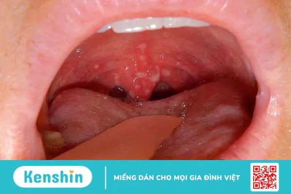 Bị đau ở cổ họng bên phải có sao không? Xử lý thế nào? 3