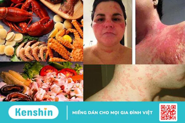 Bị dị ứng hải sản có nguy hiểm không 1