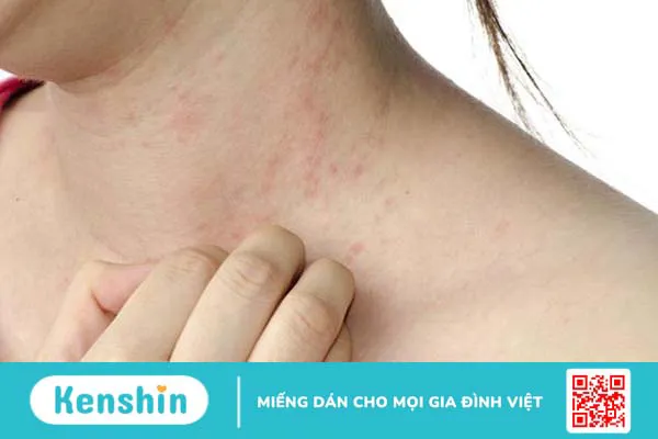 Bị dị ứng hải sản có nguy hiểm không 3