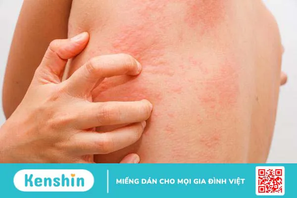 Tìm hiểu nguyên nhân, triệu chứng và cách xử lý khi bị dị ứng nước ngọt 1