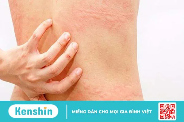 Tìm hiểu nguyên nhân, triệu chứng và cách xử lý khi bị dị ứng nước ngọt 3