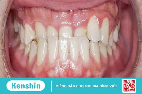 Bị móm có nên niềng răng? Quá trình niềng răng móm mất bao lâu? 1