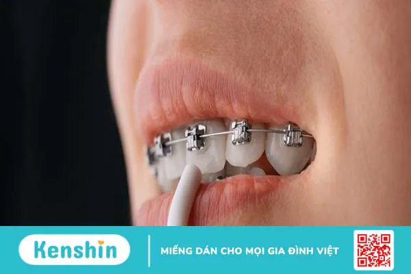 Bị móm có nên niềng răng? Quá trình niềng răng móm mất bao lâu? 2