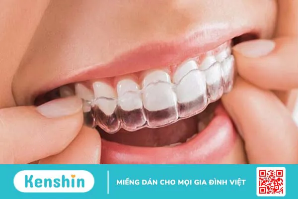 Bị móm có nên niềng răng? Quá trình niềng răng móm mất bao lâu? 3