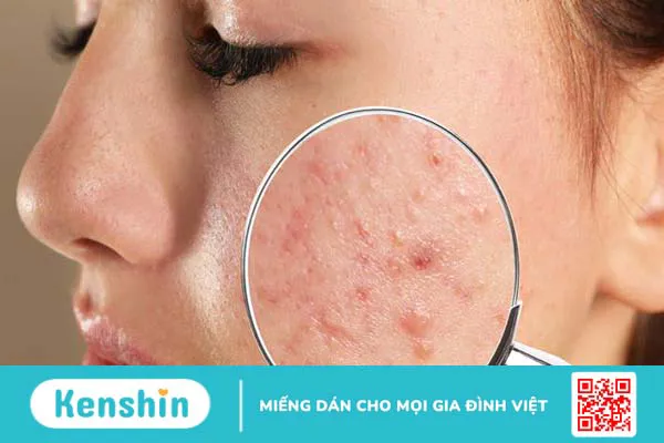 Bị mụn có nên ăn trứng không? Nên bổ sung thực phẩm gì? 1