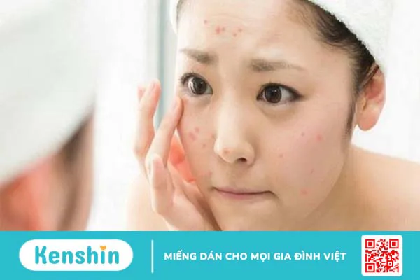 Bị mụn nên uống vitamin gì 01