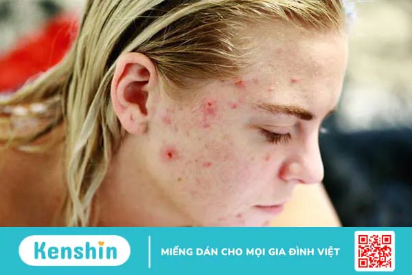 Bị mụn viêm có nên đắp mặt nạ đất sét không 1