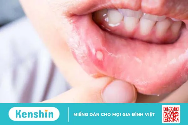 Bị nhiệt miệng nên ăn trái cây gì để lành nhanh 1