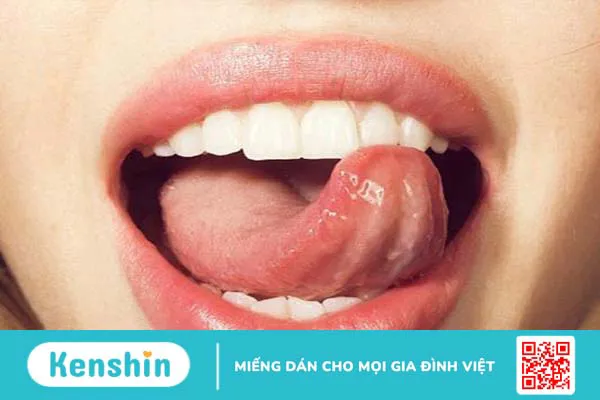 Bị nhiệt miệng nên ăn trái cây gì để lành nhanh 2