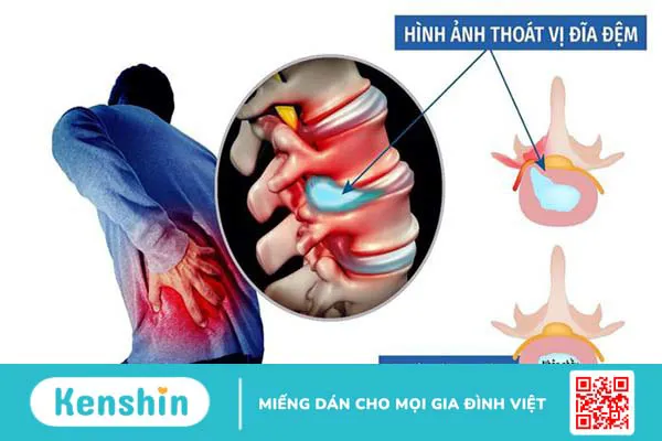 Bị rách vòng xơ đĩa đệm có nguy hiểm không? 3